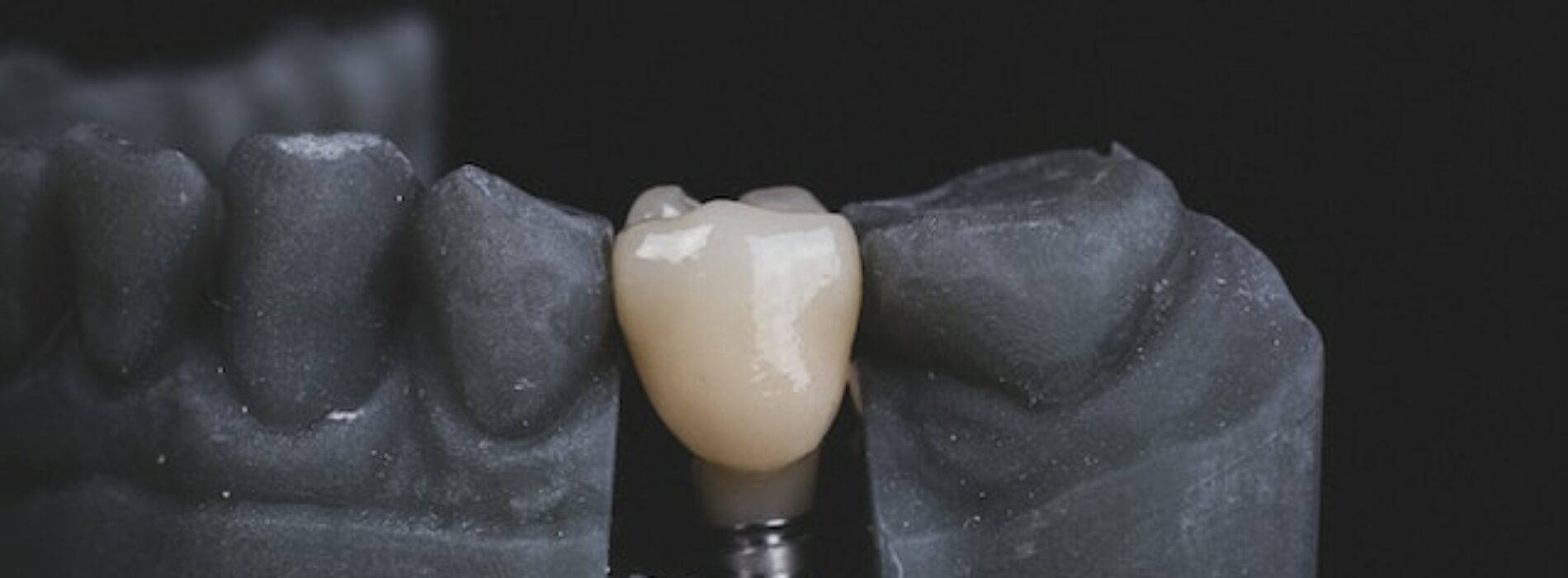 Popularne mity na temat implantów zębowych