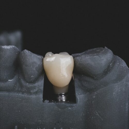 Popularne mity na temat implantów zębowych